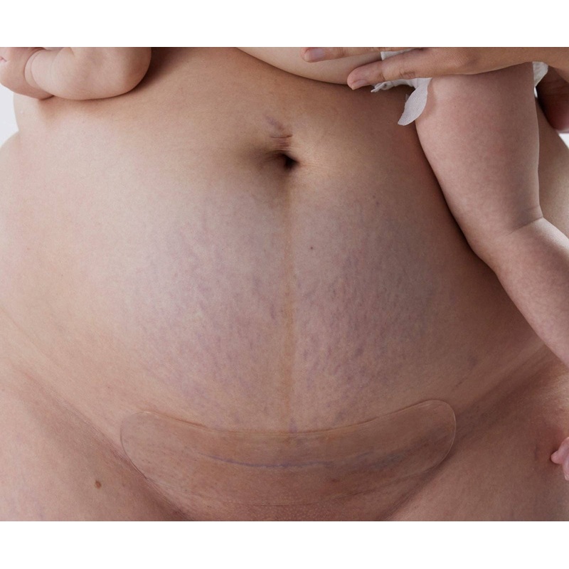 Bare Mum – Silicone Gel Scar Strips 3 STRIPS